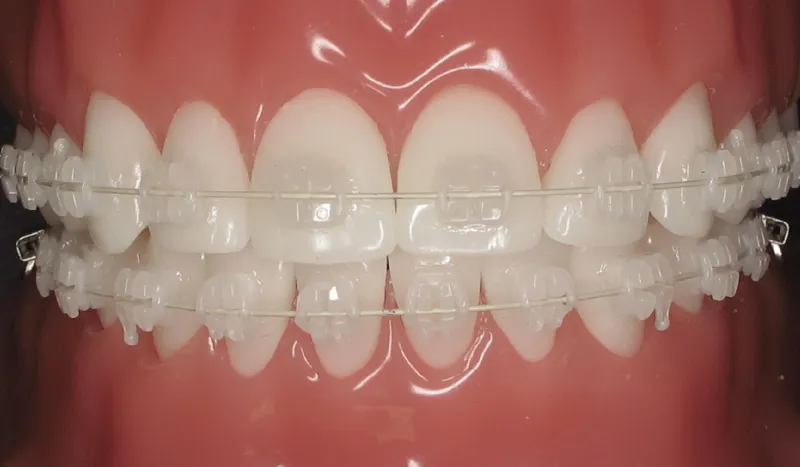 tooth coloured braces, transparent braces