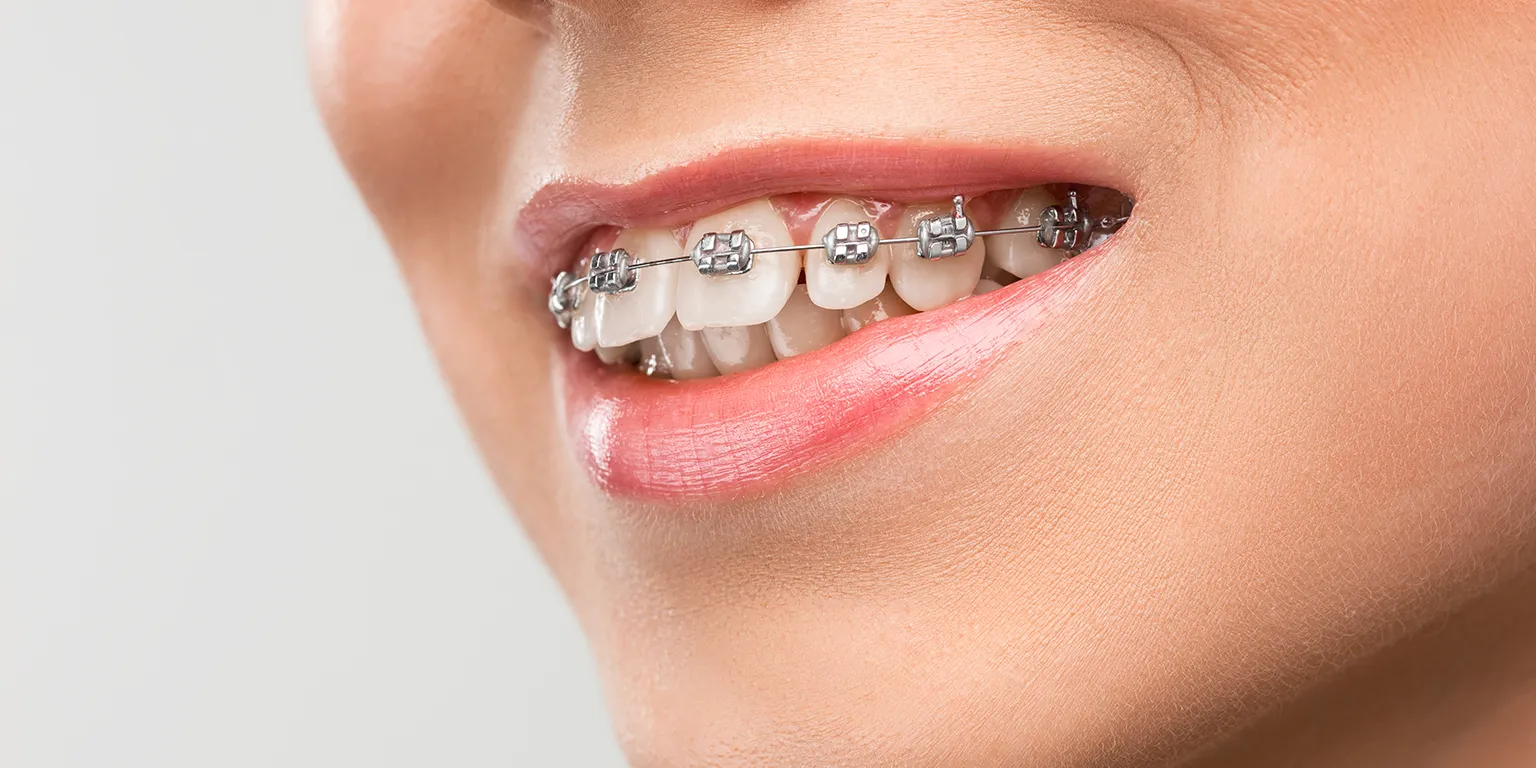 transparent braces, tooth coloured braces