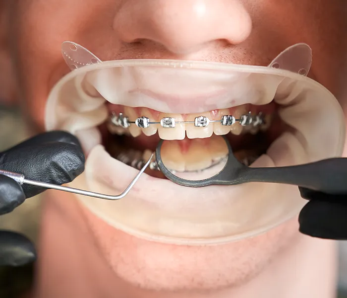 Teeth Straightening: Transforming Smiles with Precision