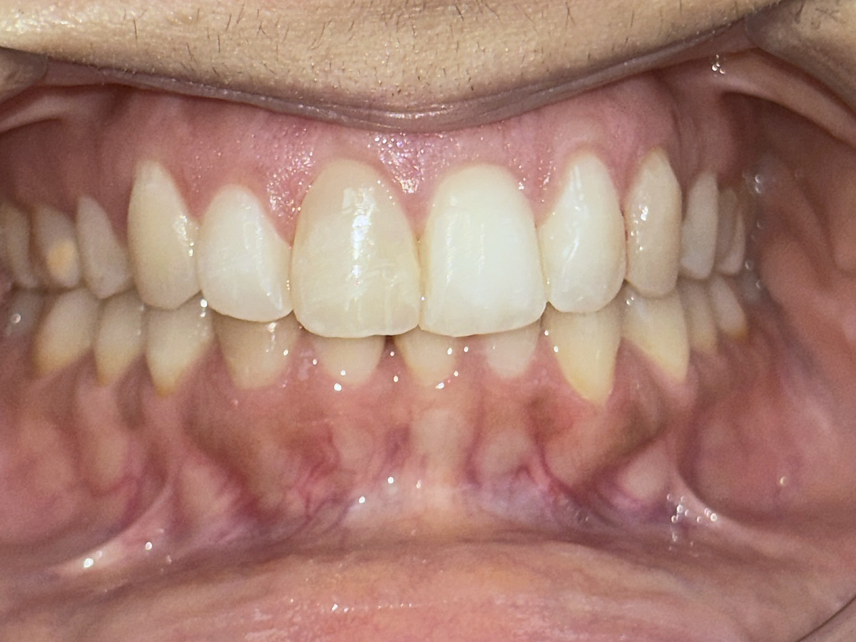 After treatment, front view of corrected crowding and deep bite