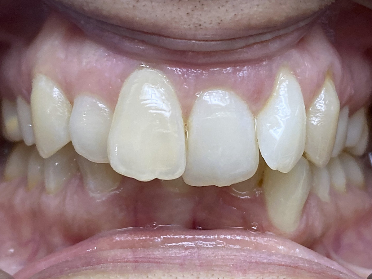 Before treatment, front view of crowding and deep bite