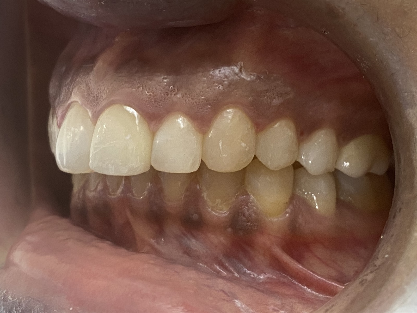 After treatment, left lateral view