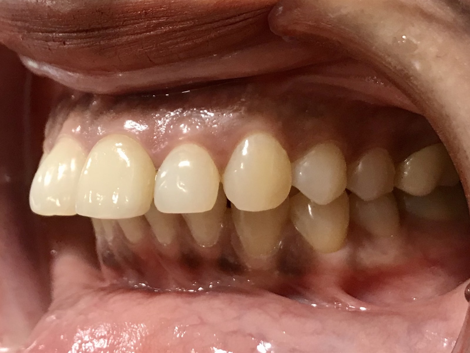 Before treatment, left lateral view