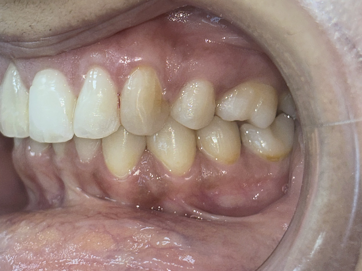 After treatment, left lateral view of corrected crowding and deep bite