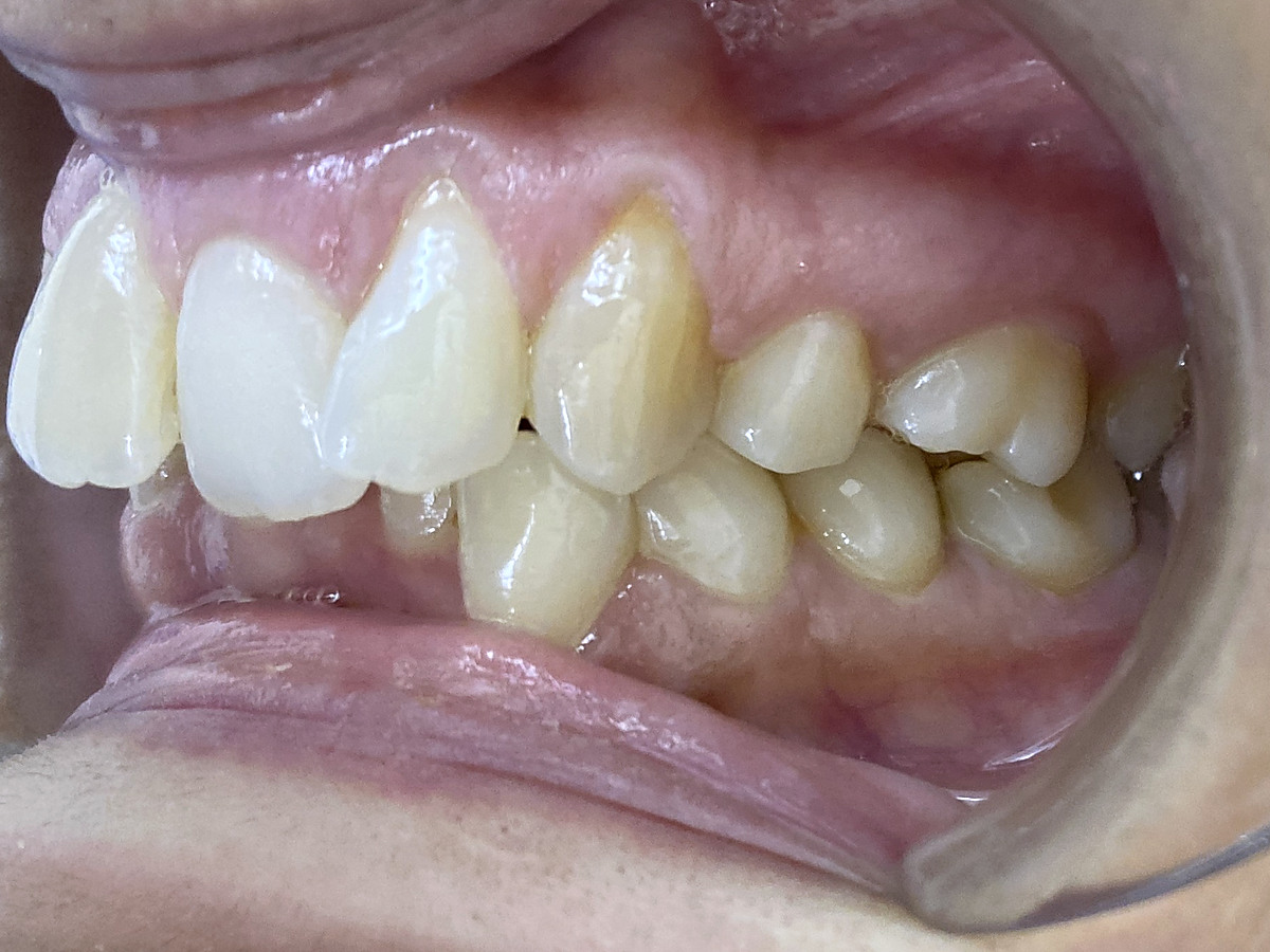Before treatment, left lateral view of crowding and deep bite