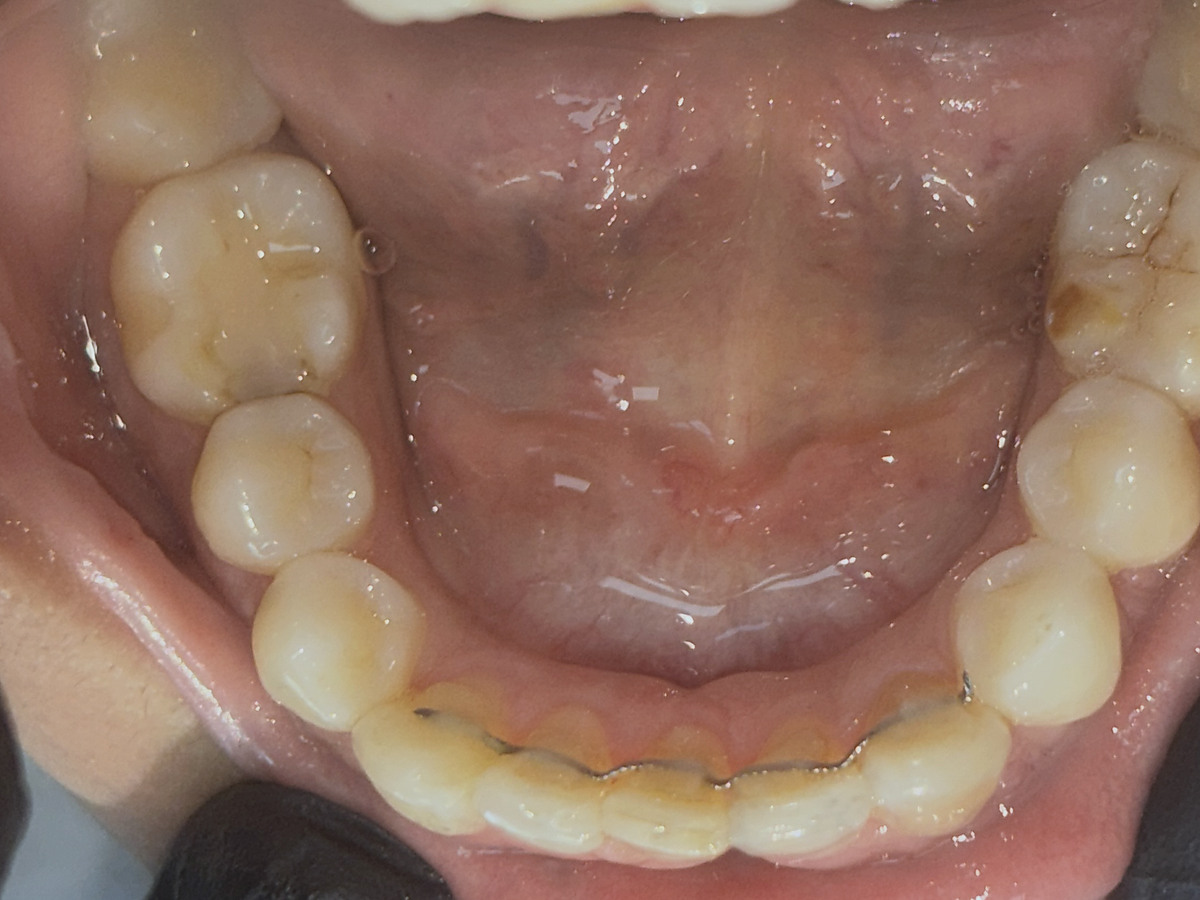 After treatment, lower arch view showing improved alignment