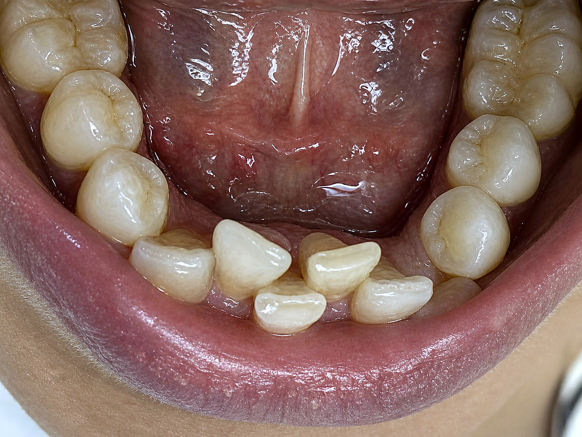 Before treatment, lower arch view showing crowding