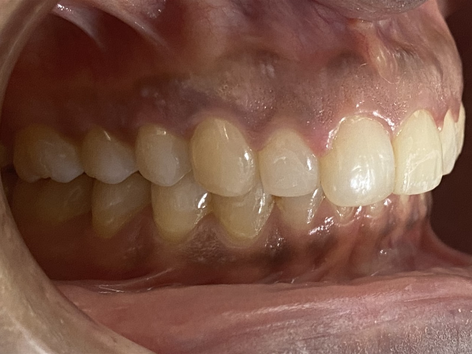 After treatment, right lateral view