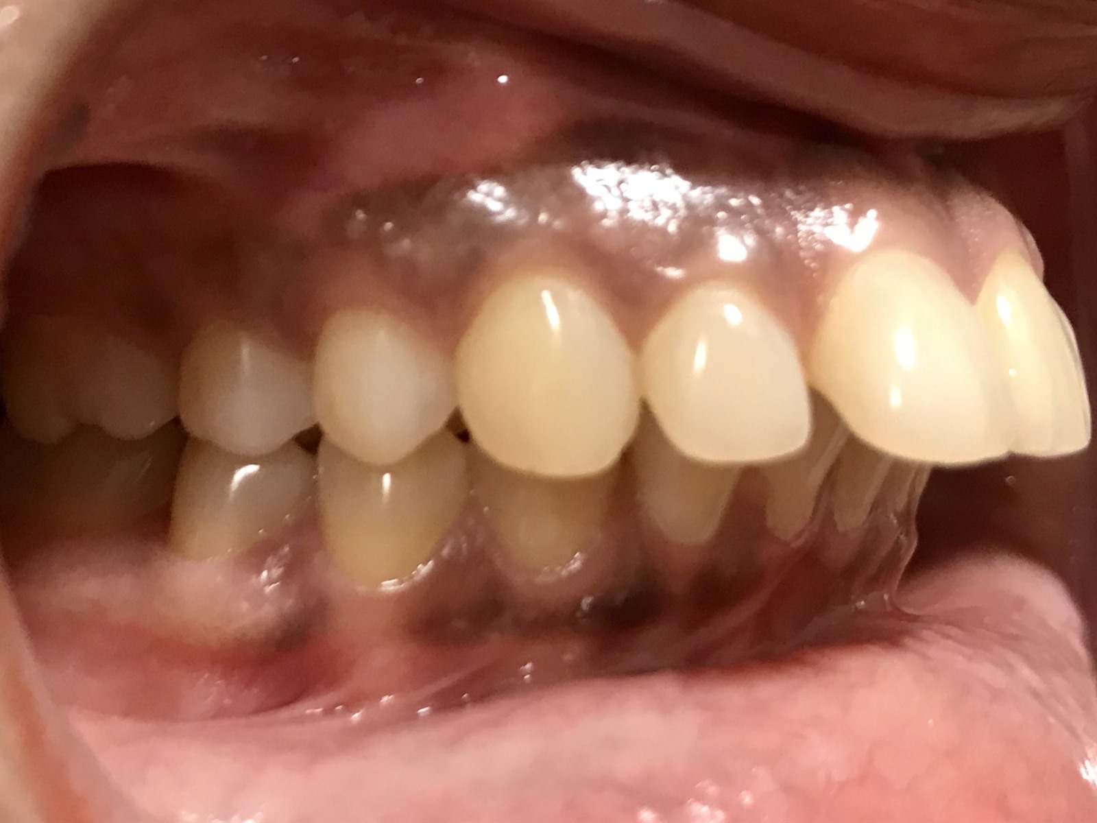 Before treatment, right lateral view