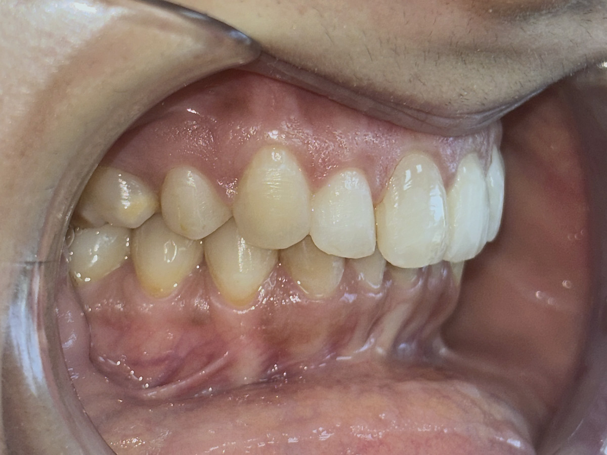 After treatment, right lateral view of corrected crowding and deep bite
