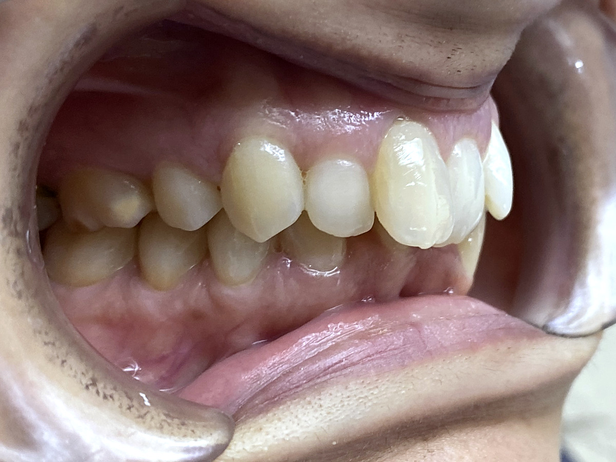 Before treatment, right lateral view of crowding and deep bite