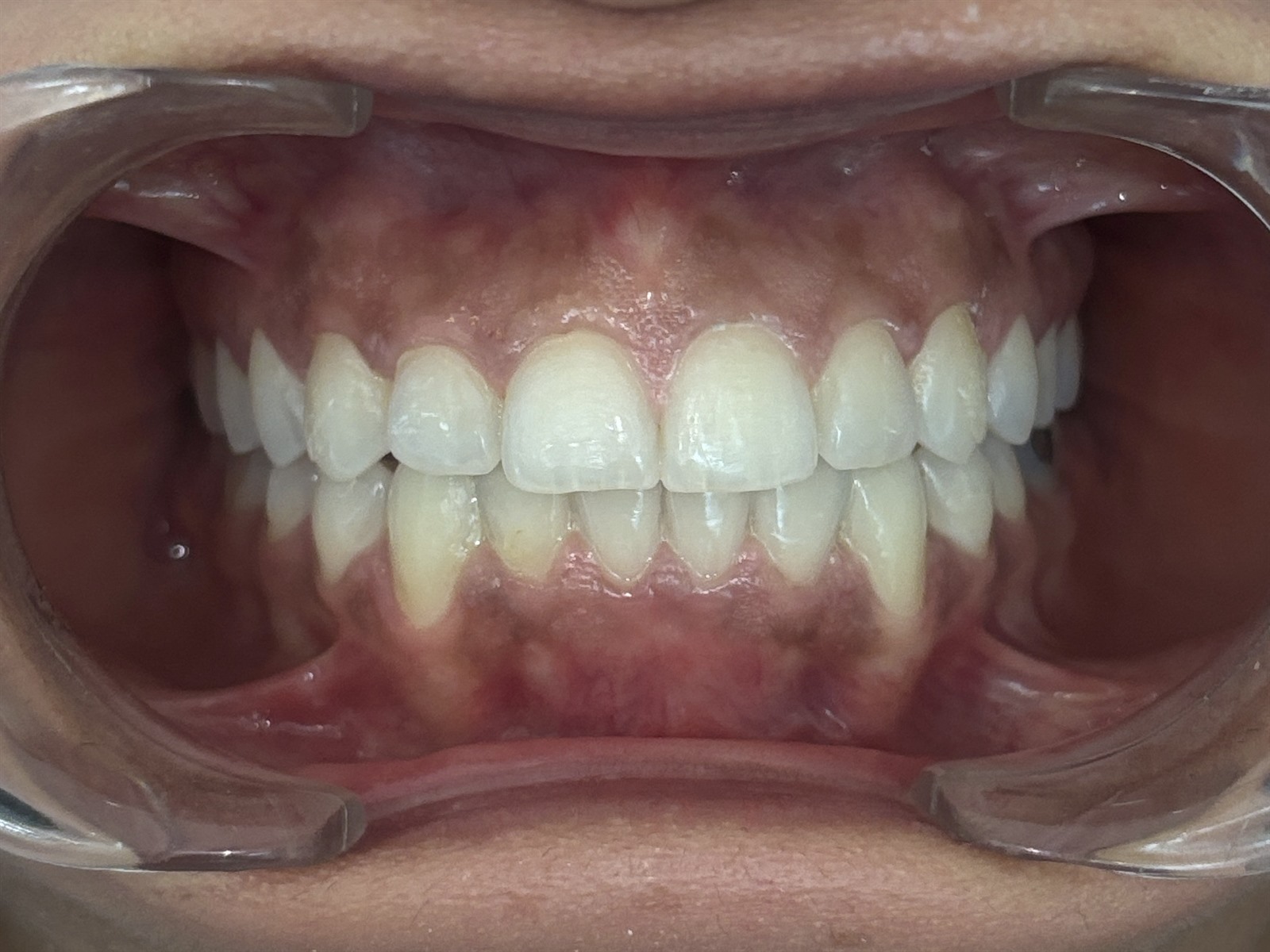 After treatment, anterior view