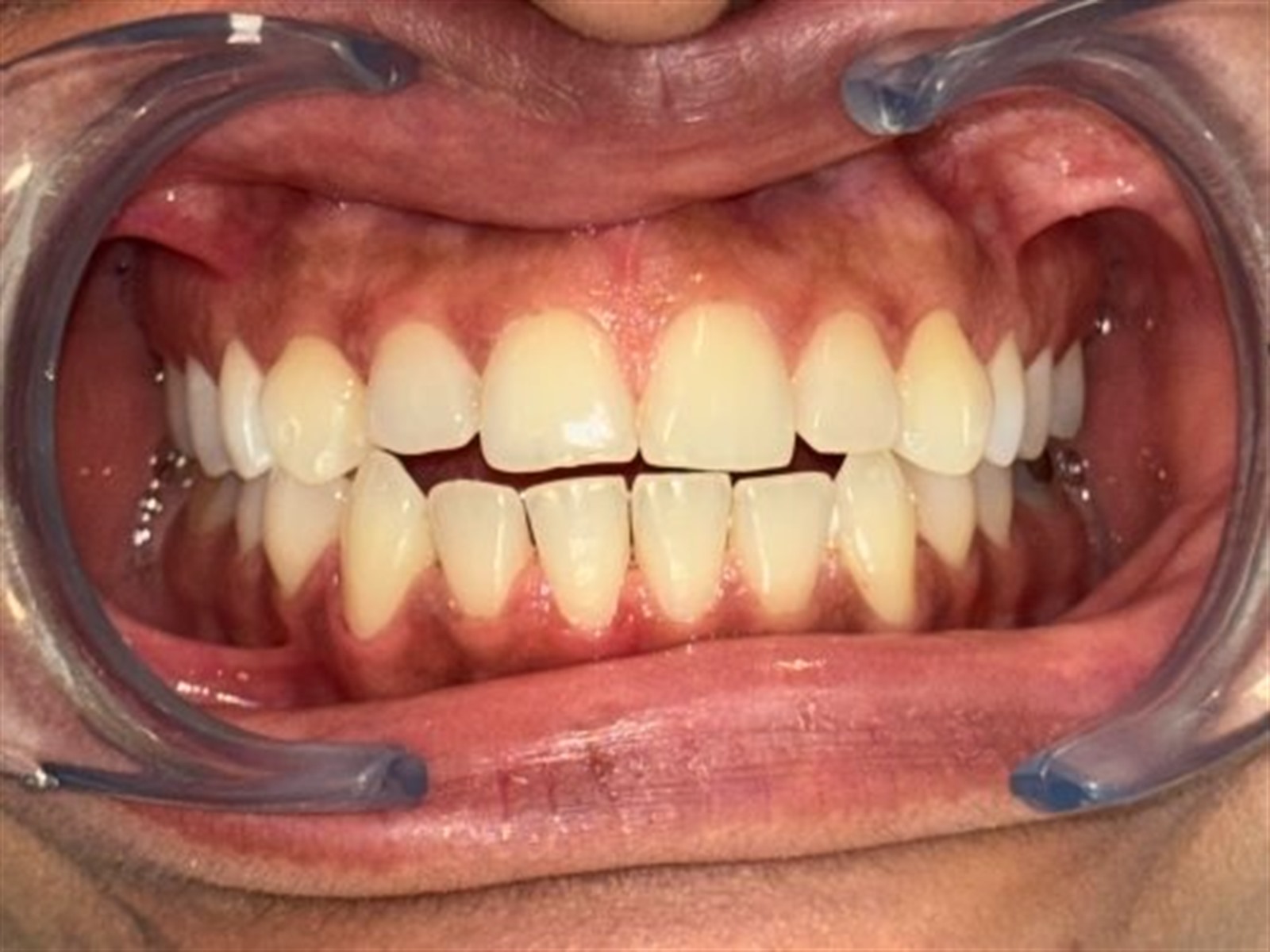 Before treatment, anterior view