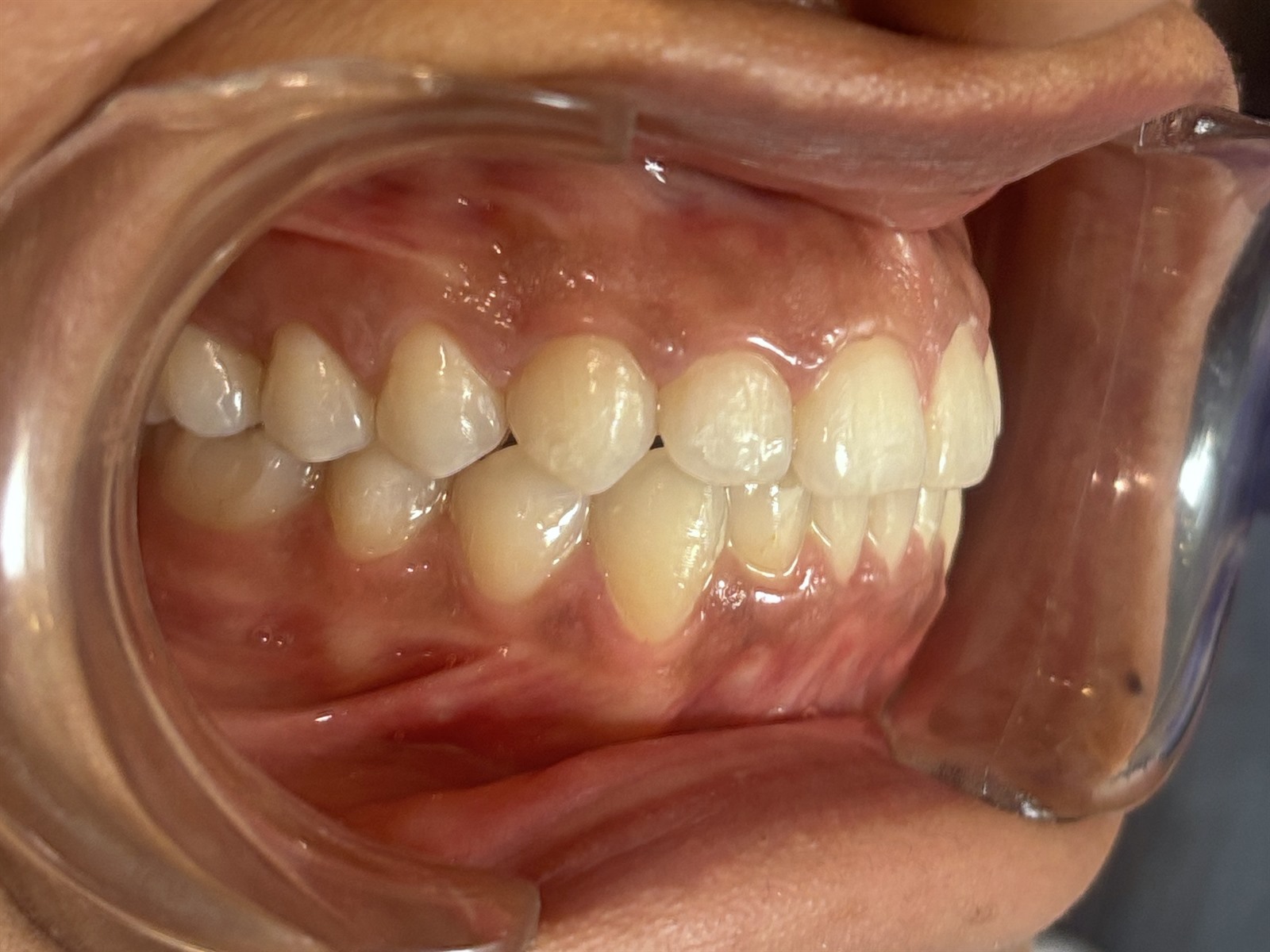 After treatment, right buccal view