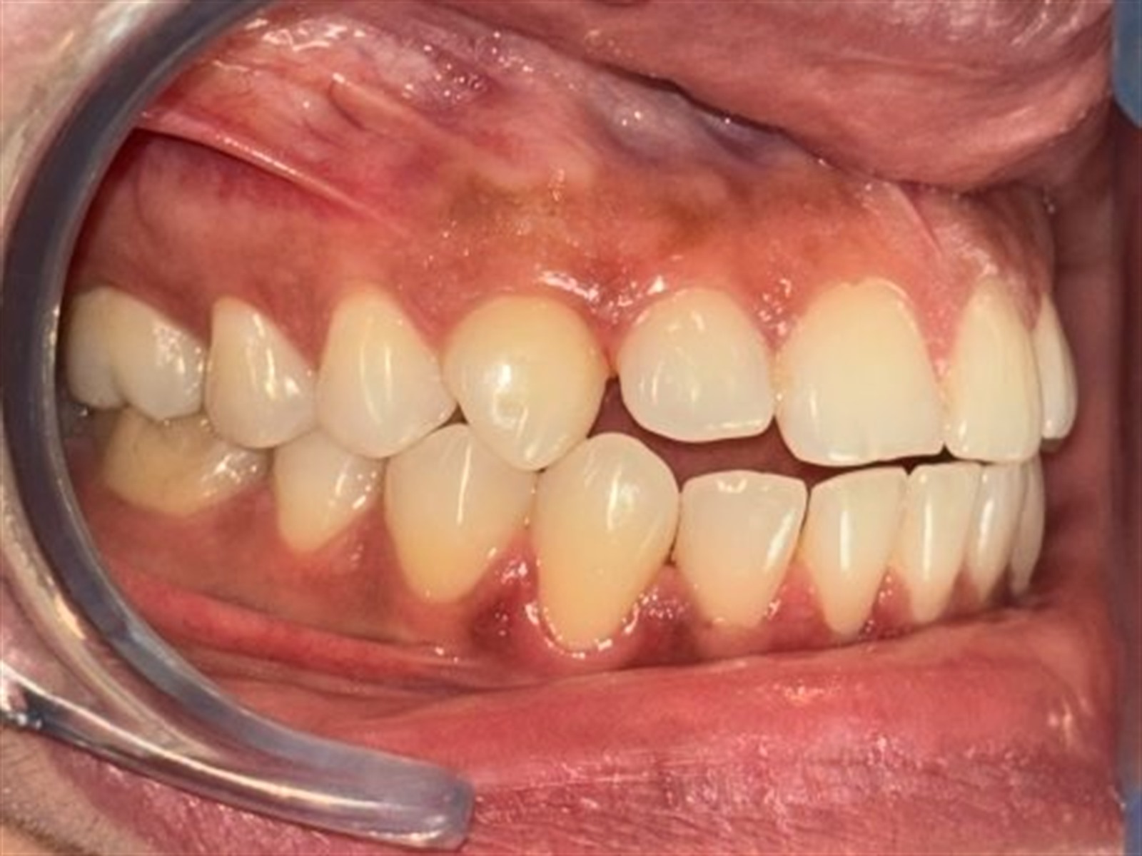 Before treatment, right buccal view