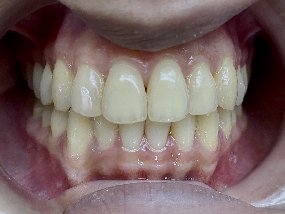 After clear-aligner treatment, front view of corrected crossbite