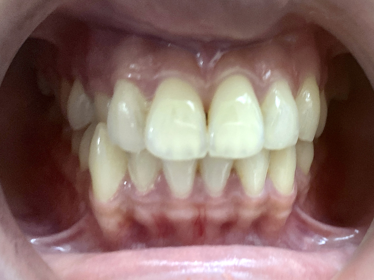 Before treatment, front view of crossbite