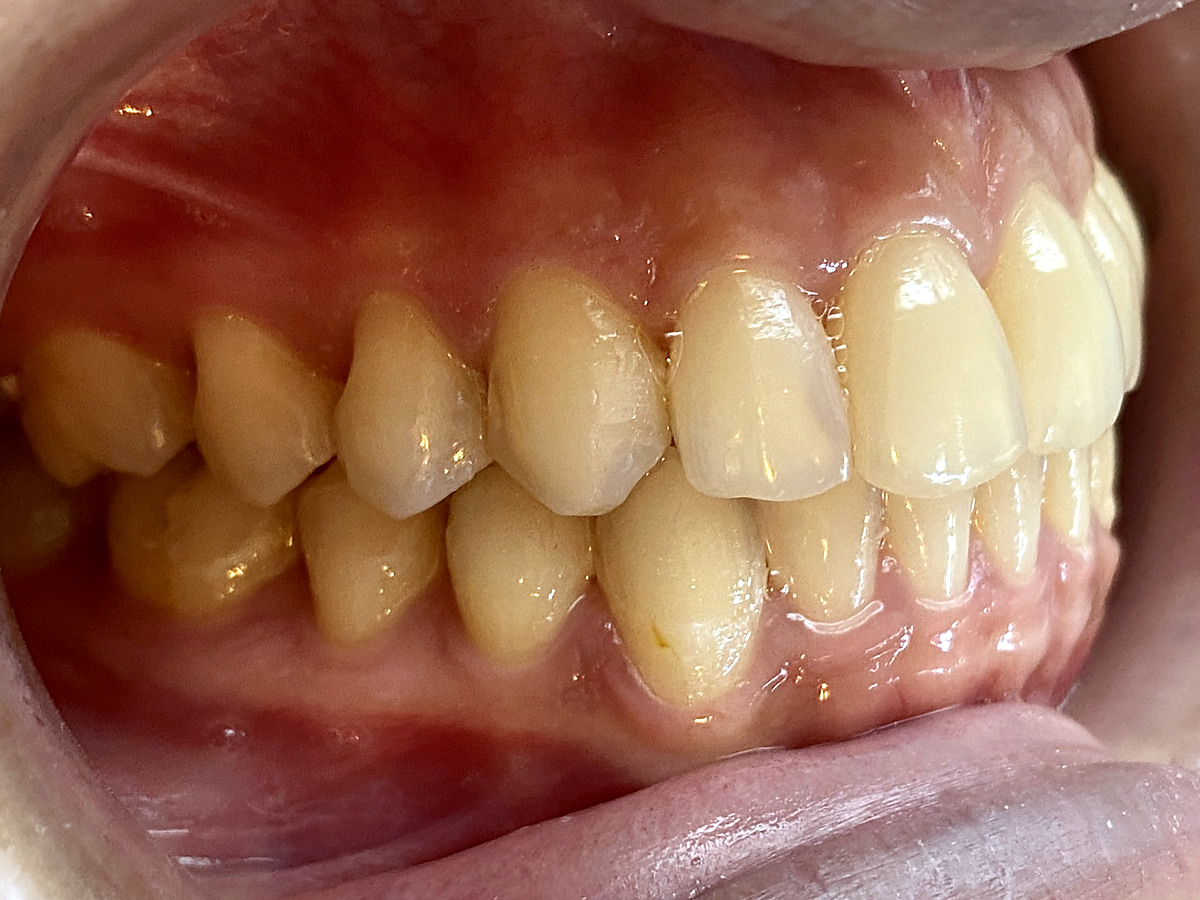 After clear-aligner treatment, right lateral view of corrected crossbite