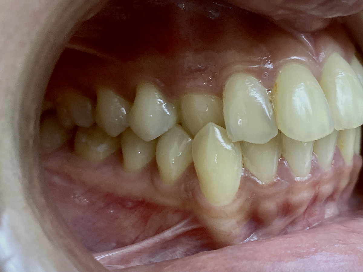 Before treatment, right lateral view of crossbite