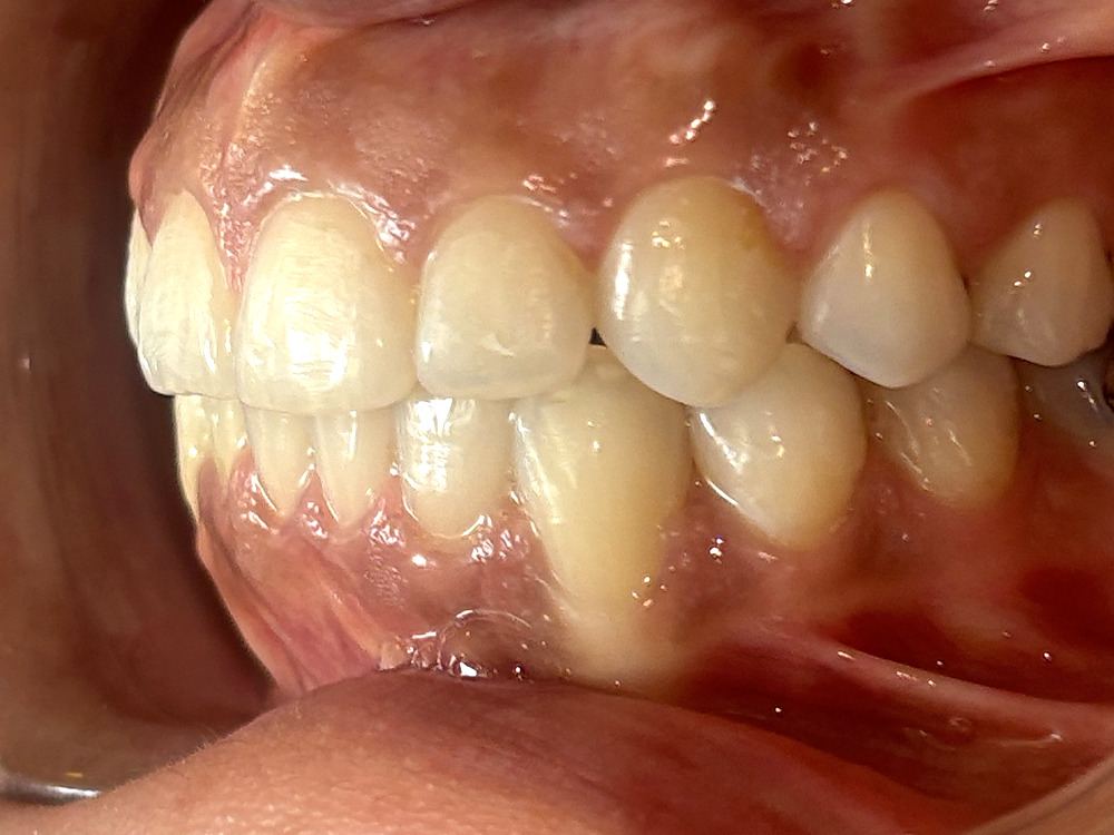 After treatment, left buccal view