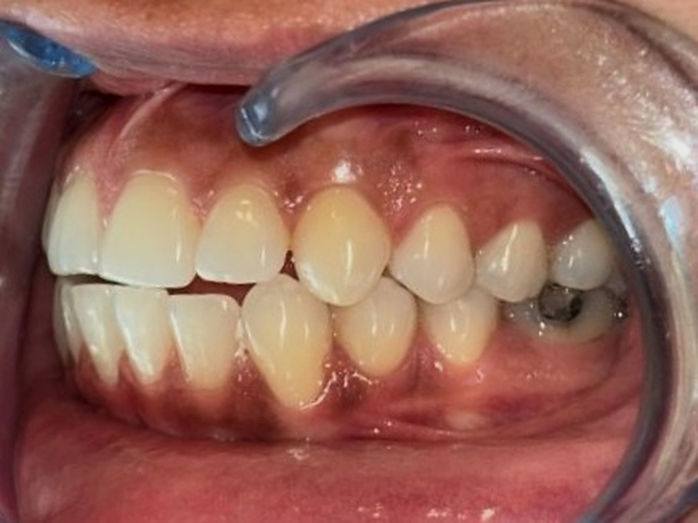 Before treatment, left buccal view