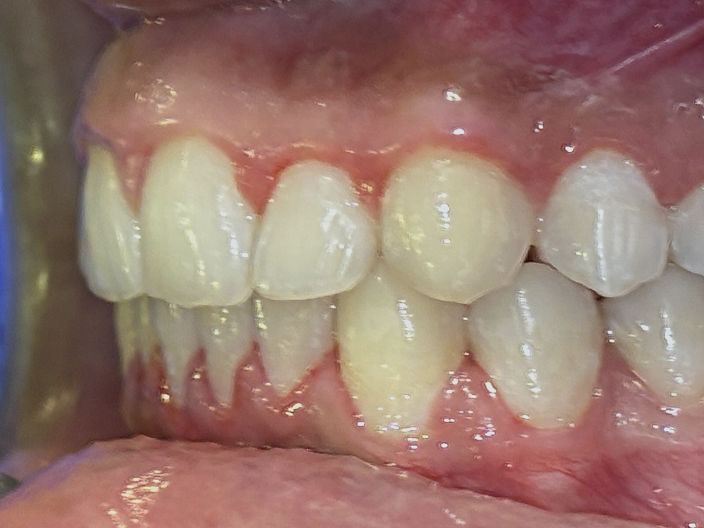 After treatment, left buccal view
