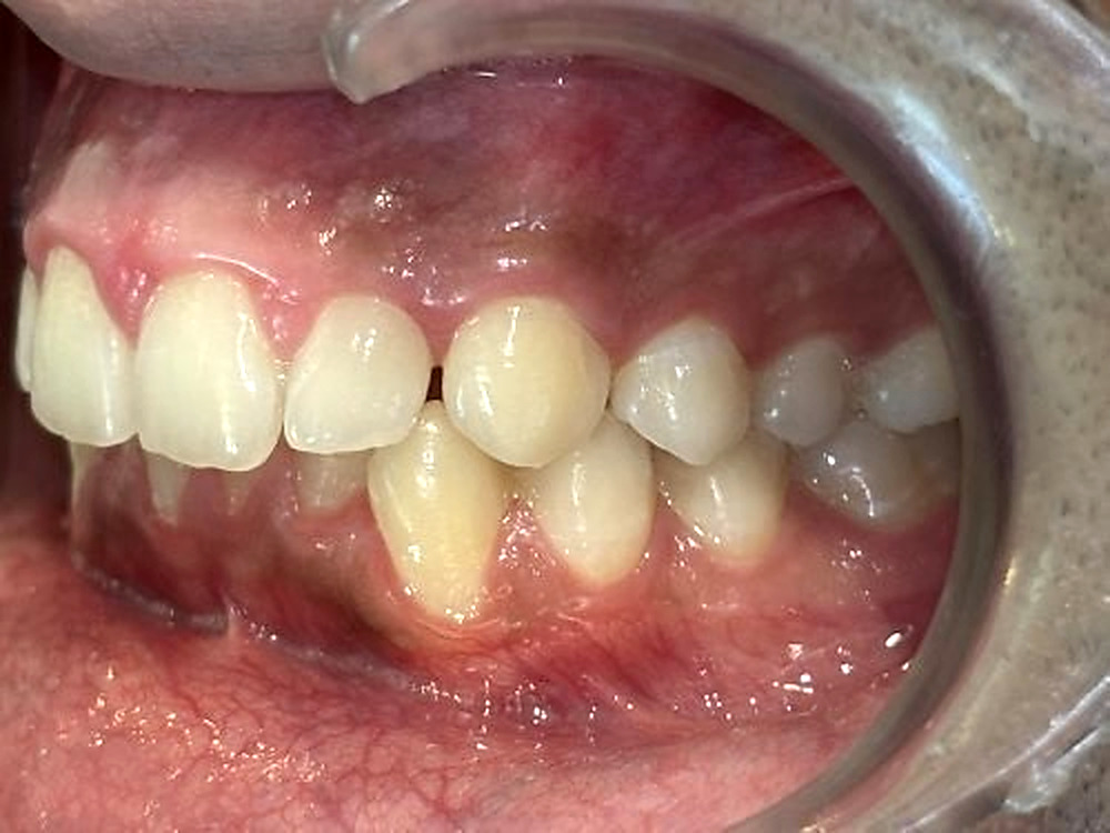 Before treatment, left buccal view