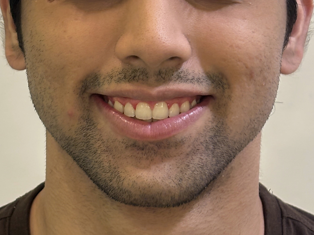 After treatment, mouth-only smile view showing reduced gingival display