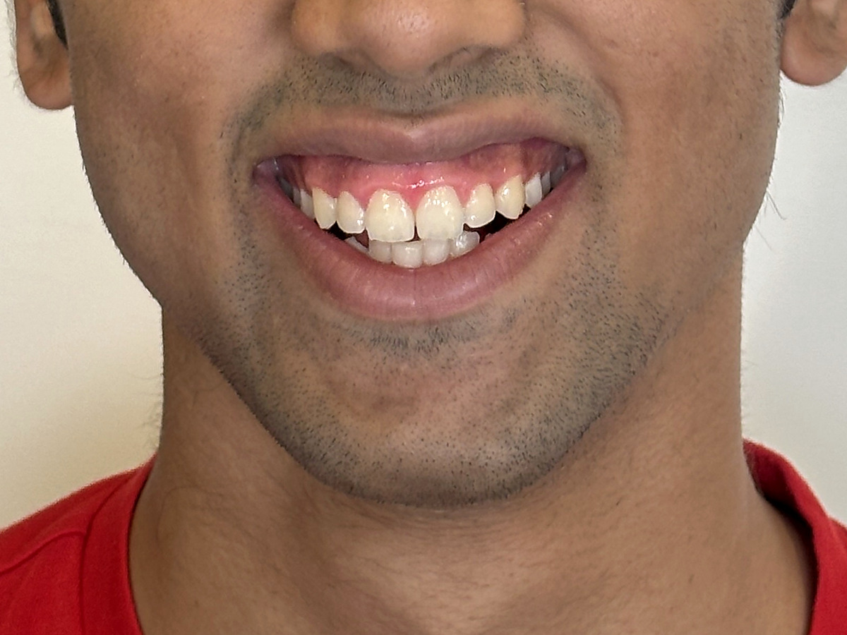 Before treatment, mouth-only smile view showing gingival display