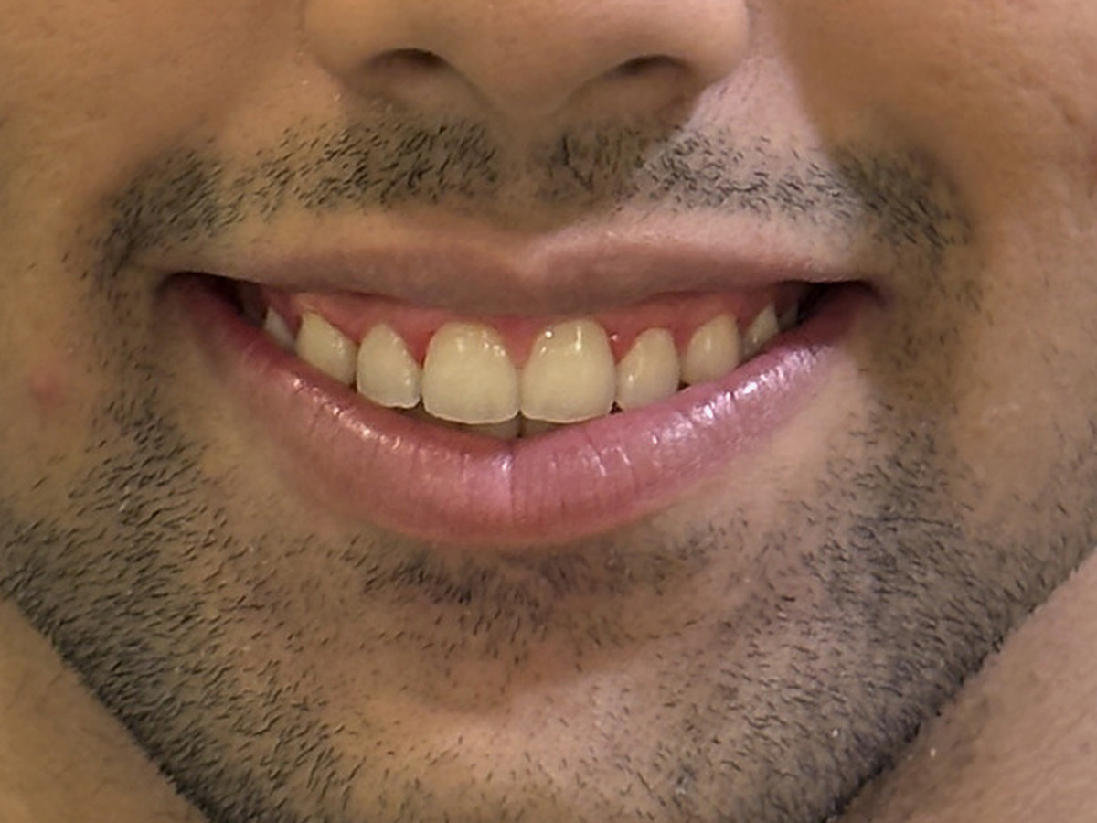 After treatment, mouth-only smile view showing reduced gingival display