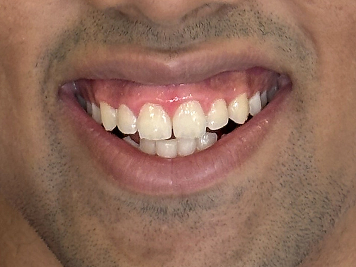 Before treatment, mouth-only smile view showing gingival display